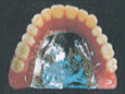 金属床義歯チタン